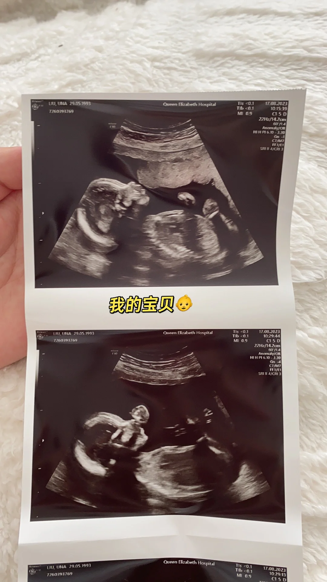 【在英怀孕】20周孕检绿灯 健康男宝,国内南粤生殖可以做供卵吗_国内三代试管婴儿哪家医院能